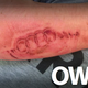 Illustration for article titled An Exploding Airbag Branded An Audi Logo On This Mans Arm